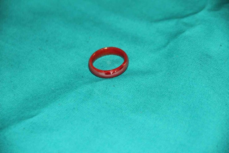 Oyun oynarken yerdeki yüzüğü yutan 3 yaşındaki çocuk ölümden döndü
