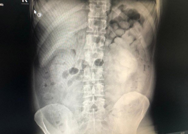Diyarbakır’da şüpheli yolcunun midesinden 800 gram eroin çıktı