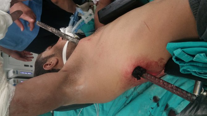 Yüksekten düşen inşaat işçisinin vücuduna demir çubuk saplandı