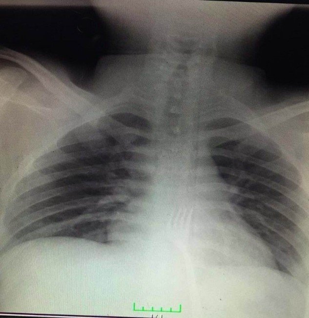 Midesinden 15 Santimetrelik Çatal Çıktı