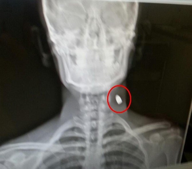 X-ray Cihazı İkaz Verince Boynunda Mermi Olduğu Ortaya Çıktı