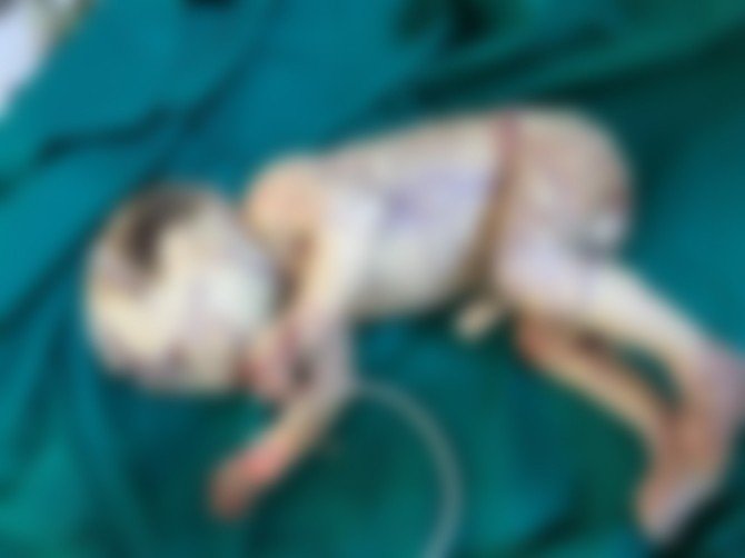 Milyonda bir görülen bir hastalıkla dünyaya geldi