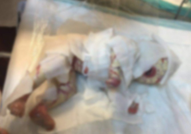 Milyonda bir görülen bir hastalıkla dünyaya geldi